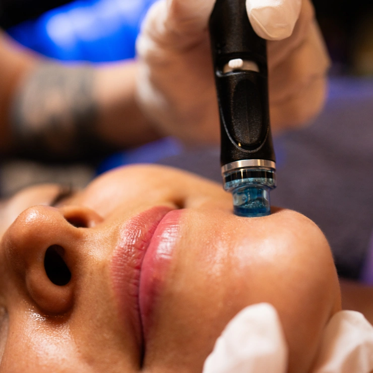Hydrafacial